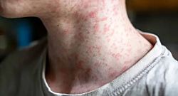 Нью-Джерси выпустил предупреждение о вреде для здоровья после того, как пассажир с корью пролетел через аэропорт Ньюарка