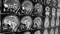 FDA одобрило новое лечение болезни Альцгеймера, которое замедляет ухудшение памяти
